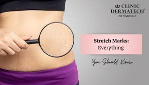 stretch marks everything you should