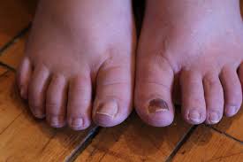 black toenails podiatry ociates p c