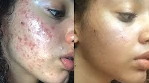 this all natural acne skin care routine