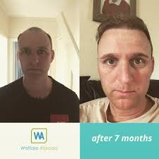 It's very common for one side of the hairline to develop first. Welfare Abroad Boost The Regrowing Process Is A Long Journey But On Average 5 To 7 Months After A Hair Transplant Operation The Growth Rate Is Boosted
