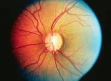 Image result for icd 10 code for primary open-angle glaucoma bilateral moderate stage