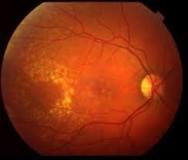 Image result for icd-10 code for macular degeneration both eyes