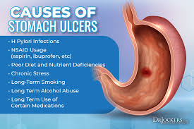 stomach ulcers causes and natural