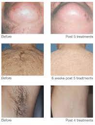 laser hair removal treatment at faces