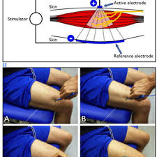 Position Of The Muscle Motor Points For The Quadriceps And