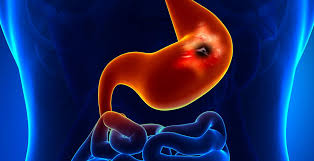 stomach ulcer symptoms causes and