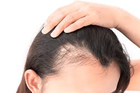female hair thinning at the crown and