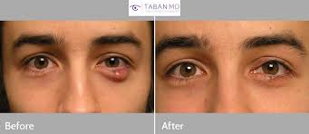 eyelid chalazion surgery before and