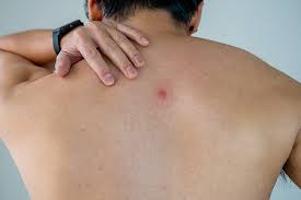 skin abscess causes symptoms