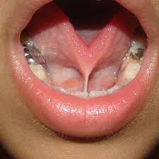 short lingual frenulum causes and