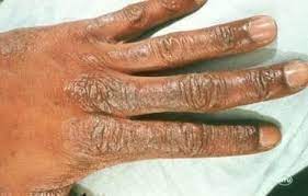 dry skin xerosis dermatology