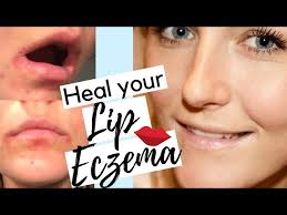 lip eczema treatment