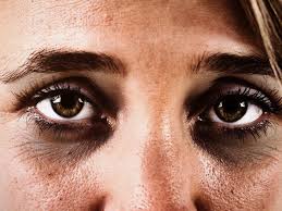 dark circles under the eyes causes and