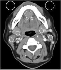 sn kv for head and neck tumor imaging