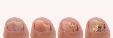 what causes toenail fungus and how to