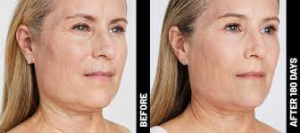 brows neck chest chin ultherapy