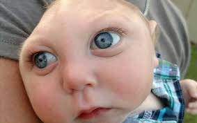 Image result for image of zika baby