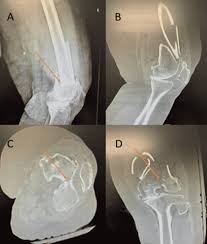supracondylar distal femur fracture