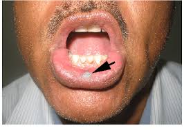whitish patch seen on the lower lip