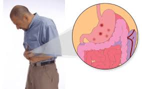 Penyakit berikutnya disebut dengan gastritis yang merupakan peradangan yang terjadi pada dinding lambung. Definisi Penyakit Maag Akut Bersosial Com