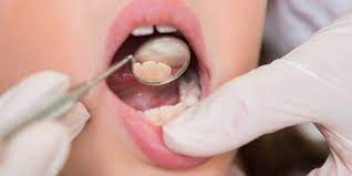 how to cure tooth infection dental