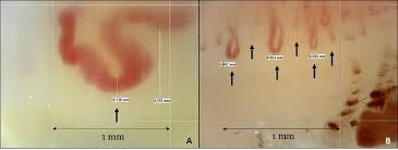 the impact of nailfold capillaroscopy