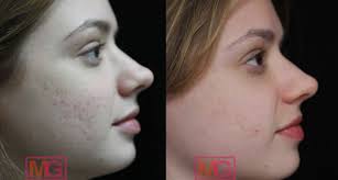 here s how dermal fillers can get rid