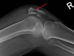 Technical considerations for mri evaluation of the knee extensor mechanism. Patella Fracture Wikipedia