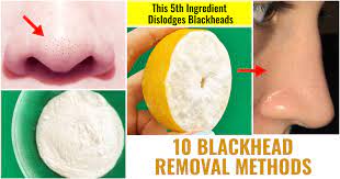 ing blackheads removal methods