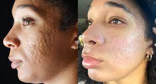 do acne scars look worse as you age