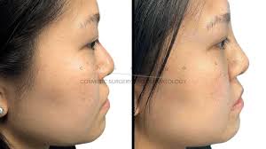 non surgical nose reshaping chicago