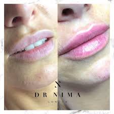 lip fillers in london with dr nima