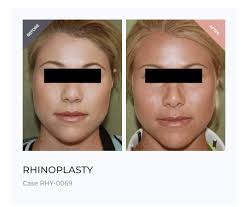 the guide to bulbous nose rhinoplasty