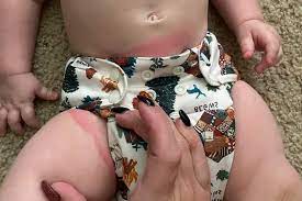 cloth diapers leaving marks on your