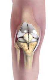 minimally invasive knee joint