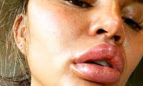 lips had a major allergic reaction