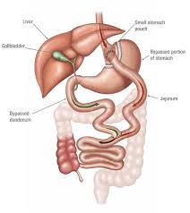 gastric byp surgery everything you