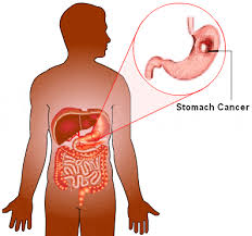 The symptoms of stomach cancer are in two distinct stages it is common for people with early stage stomach cancer to experience no symptoms. Stomach Cancer Treatment In India Esophagus Tumor Therapy Tamil Nadu Symptoms Of Esophagus Cancer Madurai