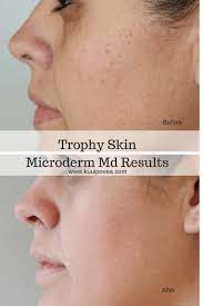 Before, professional microdermabrasion machines were just available in salons. Microdermmd Before And After Ku Uipo Vea