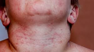 heat rash on face symptoms treatments