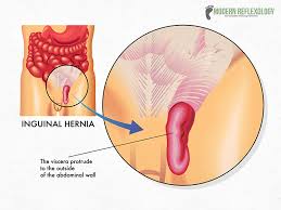 Best 3 Acupressure Points For Treating Different Types Of Hernia