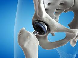 hip replacement surgery in singapore