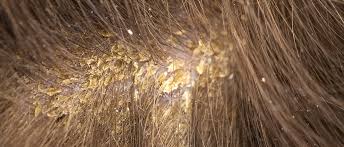 cure scalp fungus