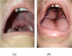 submucous cleft palate surgery