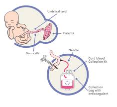 cord blood bank 1 reason to get the
