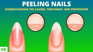 understanding ling nails what your