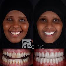 smile makeover dental excellence