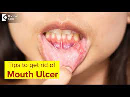 mouth ulcer mouth sores symptoms