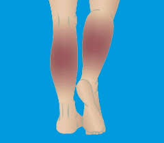 leg discoloration