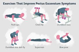 pectus excavatum exercises